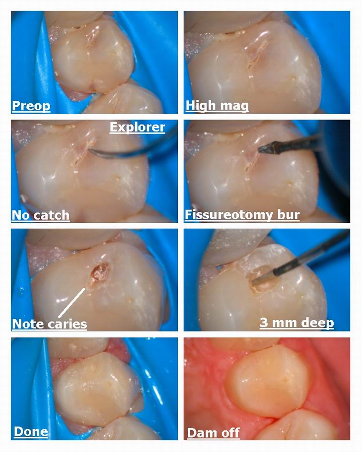 Resize of small occlusal with fissureotomy bur.jpg